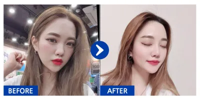 [バビトーク] 鼻整形 / 5ヶ月目 / ニックネーム：ジョンジョンイイン