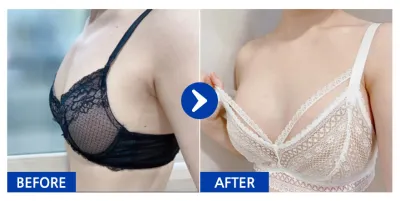 [カンナムオンニ] 豊胸整形(セビンサブ) / 1ヶ月目 / ニックネーム:チェユユ