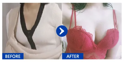 [カンナムオンニ] 豊胸整形 / 2ヶ月目 / ニックネーム：チーズマニ