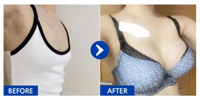 [カンナムオンニ] 豊胸整形(メンター) / 4ヶ月目 / ニックネーム:プハンハハ