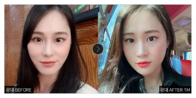 [カンナムオンニ 口コミ] 頬骨縮小術 1ヶ月目 / ニックネーム：ヒニマニム