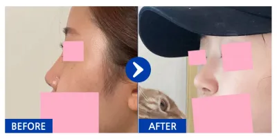 [カンナムオンニ] 鼻整形 / 2ヶ月目 / ニックネーム：ジェリリリリル