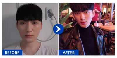 [カンナムオンニ] 鼻整形 / 4ヶ月目 / ニックネーム：ヘッギュ