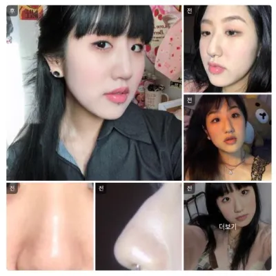 [バビトーク] 鼻整形 / 1ヶ月目 / ニックネーム：キム・ミンジ1111