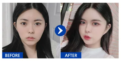 [バビトーク] 脂肪移植、輪郭整形、二重整形 / 3ヶ月目 / ニックネーム：ウアオアアアア