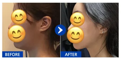 [バビトーク] 顔の脂肪吸引 / 1ヶ月目 / ニックネーム：バビトークヒ