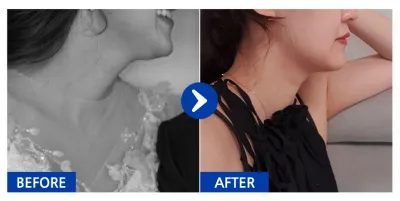 [バビトーク] 脂肪吸引 / 2ヶ月目 / ニックネーム：ダニチュチュ