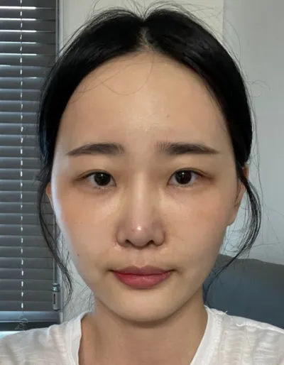 [目] ほんの少し - 埋没法二重、目頭切開、目尻切開