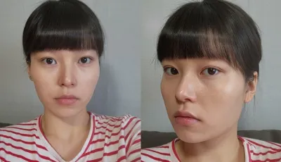 [輪郭手術] ニョムニョムさん - 顔面輪郭