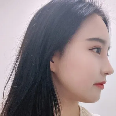 [鼻] 冬に手術 - 鼻筋、鼻先、骨切り