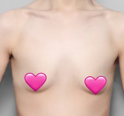 [豊胸] スムディー - 胸