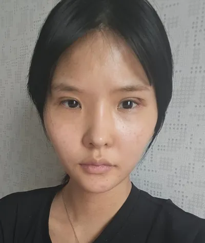 [目] ミンチョダン - 切開式眼瞼下垂矯正、目頭切開、目尻切開、グラマラスライン再手術