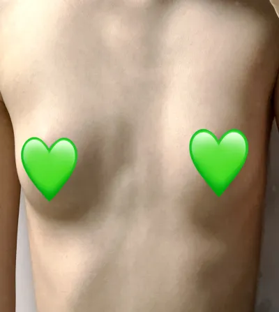 [豊胸]蚊退治 - 胸