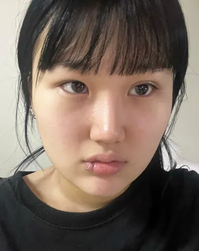 [目] グレーバナナ - 切開二重再手術、目頭切開