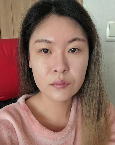 [目] チョロギ - 埋没二重、目尻切開、タレ目形成