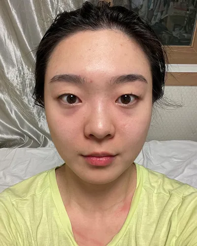 [目] パンパンダ - 目の下の脂肪再配置