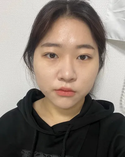 [目] チェリーゼリー - 目尻切開、タレ目形成