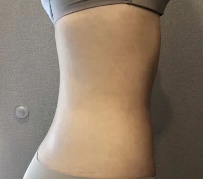 [脂肪吸引] 星のように舞い上がれ - 腹部、ふくらはぎの脂肪吸引