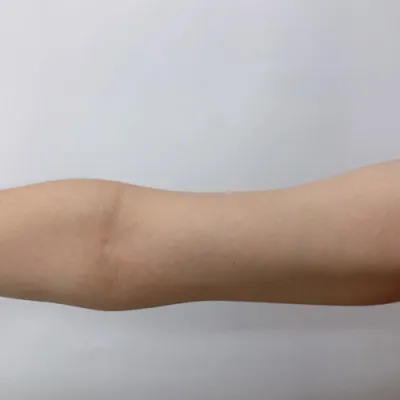 [脂肪吸引] ホットサマーサマー - 腕の脂肪溶解注射