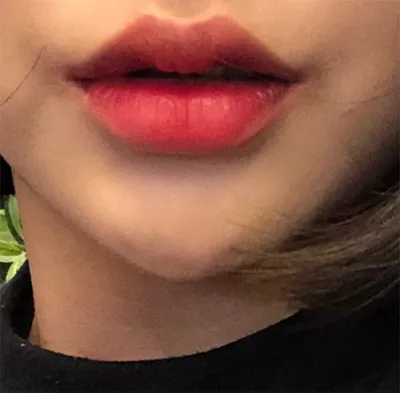 [쁘띠] ddd97 - フィラー、ボトックス