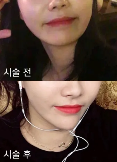 [プチ] ヤルラションス - 顎なしフィラー