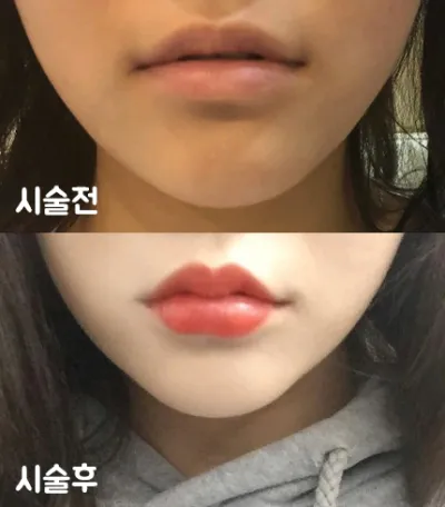 [쁘띠] bobommm - 唇フィラー