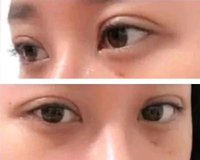 [目] ロマンチックツリー - 目