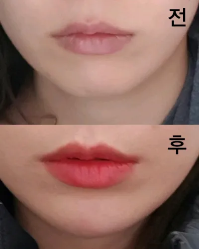 [プチ] ク - 顎先フィラー、ボトックス