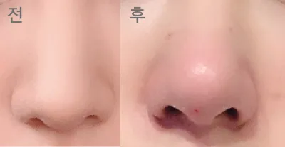 [プチ] tanatana0 - 鼻の輪郭注射