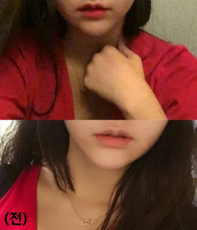 [プチ] ghyghy - 唇フィラー