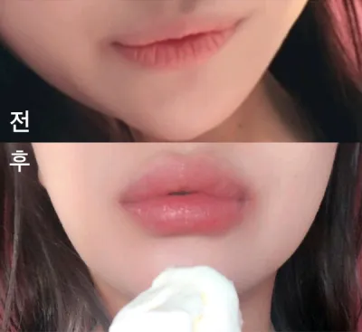 [プチ] bkbkbk - 唇フィラー