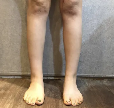 [脂肪吸引] 星のように舞い上がれ - ふくらはぎ、腹部の脂肪吸引