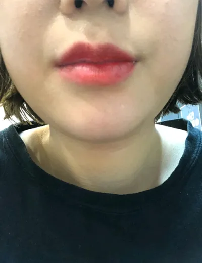 [プチ] ヨスルゴンジュ - 唇フィラー