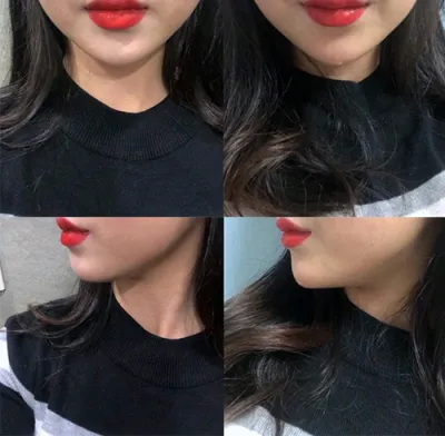 [プチ] キョムキョン - 顎先フィラー、梅干しジワボトックス