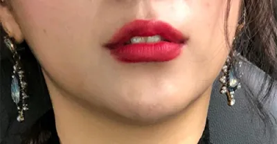 [プチ] ヨクナ - 唇フィラー