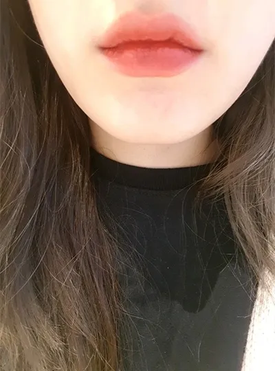 [プチ] ジットリ - 唇フィラー、ボトックス