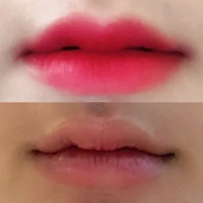 [プチ] sodh - 唇フィラー