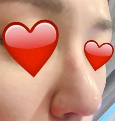 [쁘띠] 2080チヤク - 鼻の輪郭注射、ボトックス