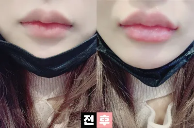 [プチ] よおおおおん - 唇フィラー