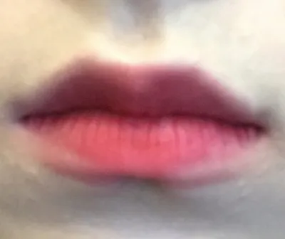 【プチ整形】二重手術成功 - 唇フィラー