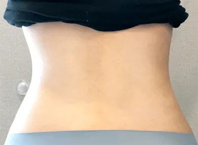 [脂肪吸引] クルタビン - ふくらはぎ、腹部の脂肪吸引