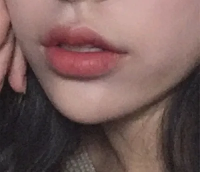 [쁘띠] なんて言うか - 唇フィラー、ボトックス