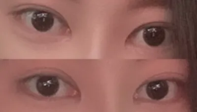 [目] ドゥチス - 目再手術