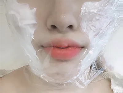 [皮膚] ㅁㅋㅌㅇㅎㅅ - シュリンク、輪郭ボトックス