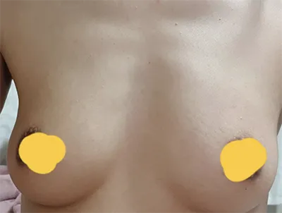 [豊胸] 희잇 - 胸