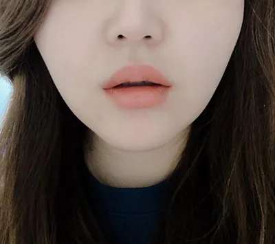 [쁘띠] ブリンイイ - 口角ボトックス、唇フィラー