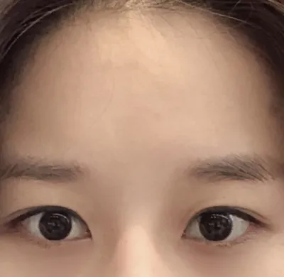 [目] スンギュン - 目尻切開、グラマラスライン形成