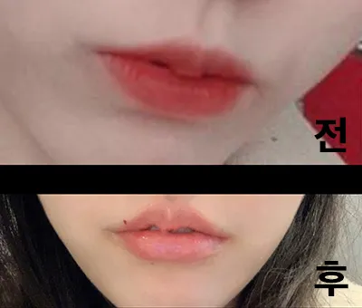 [쁘띠] うわぁぁん - 唇フィラー