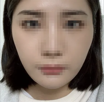 [輪郭手術] オインイーンア - 顔面輪郭、鼻、脂肪移植