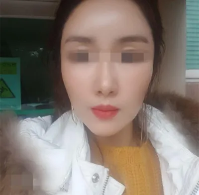 [アンチエイジング] ビンビンさんの顔への脂肪移植レビュー